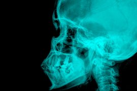 歯並びの悪化にも!? 顎偏位が全身に与える悪影響とは