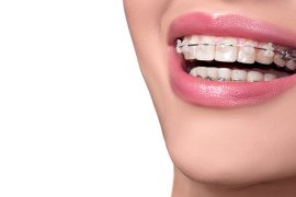 歯列矯正中でも気楽に食べられるメニューをご紹介！