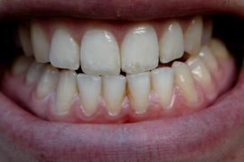 危険性が高い！　歯ぎしりなどの「咬合神経症」とは