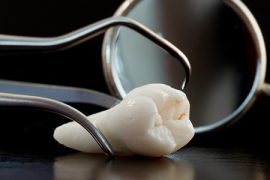 歯列矯正に抜歯は必須！？ 抜歯の本数を決める要素とは？