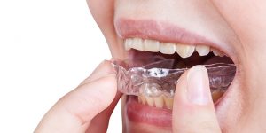 日本人は歯並びに無頓着？　外国人から見た日本人の歯並び