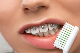 ブラケット（矯正装置）を装着している時の正しい歯磨きやケアとは？